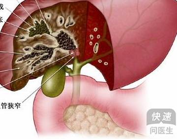 “最新研发的肝胆管结石治疗药物介绍”